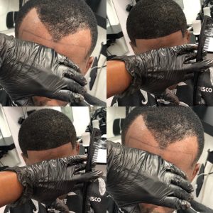 Hair line restoration LA