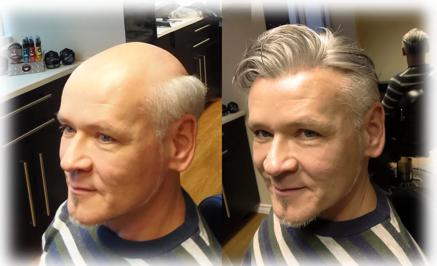 hair replacement Caucasian