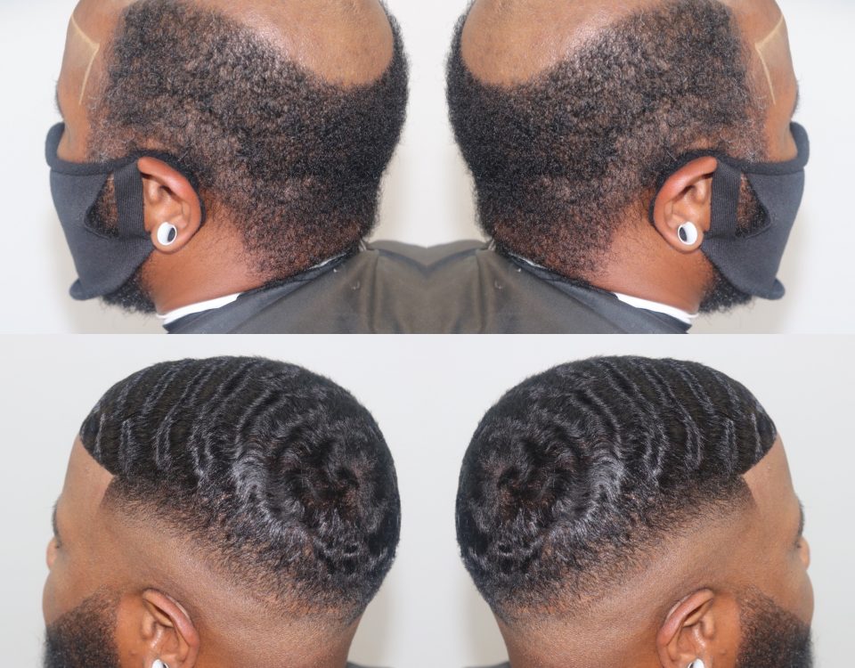 Hair unit Coronavirus