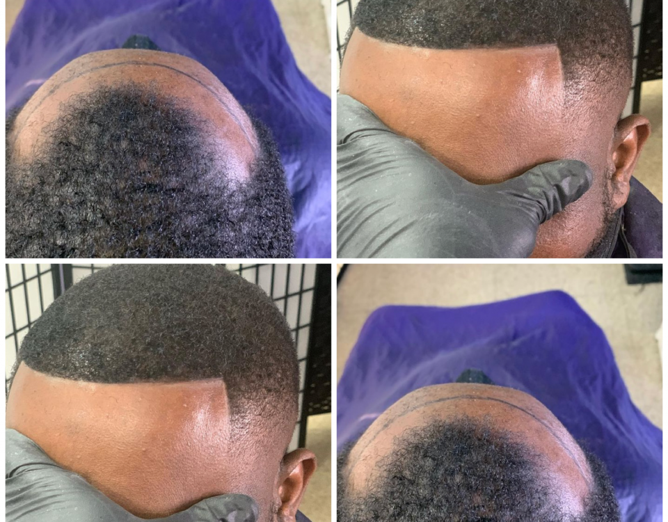 frontal hair restoration unit