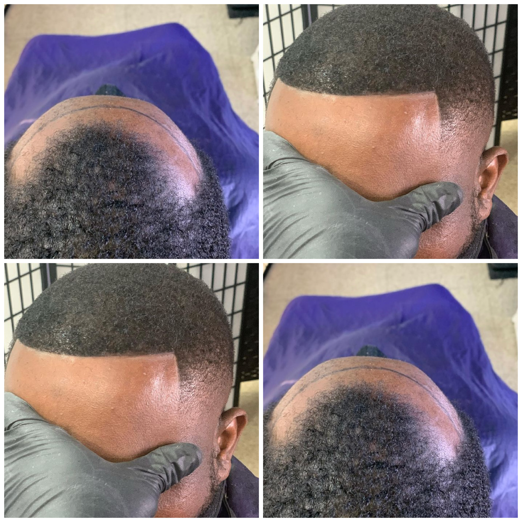 frontal hair restoration unit