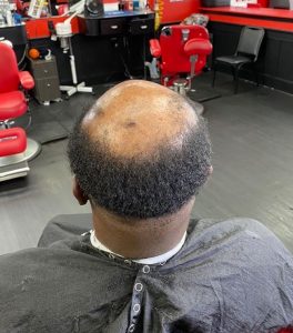 balding man