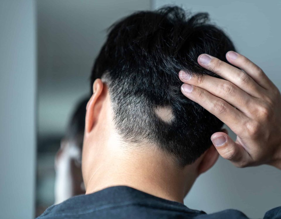 Bald spot on mans head