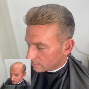 Hair replacement lafayette