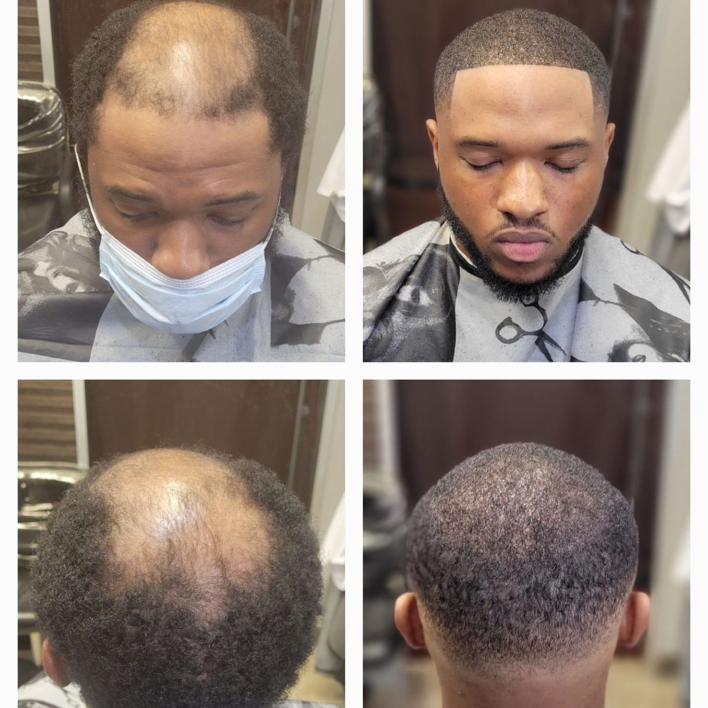hair replacement bowie md