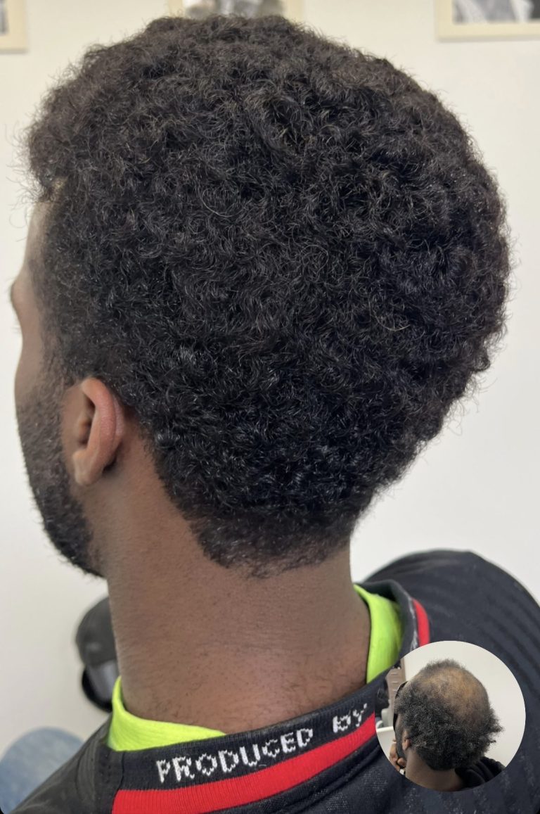 Hair unit work by IHS Hair Replacement
