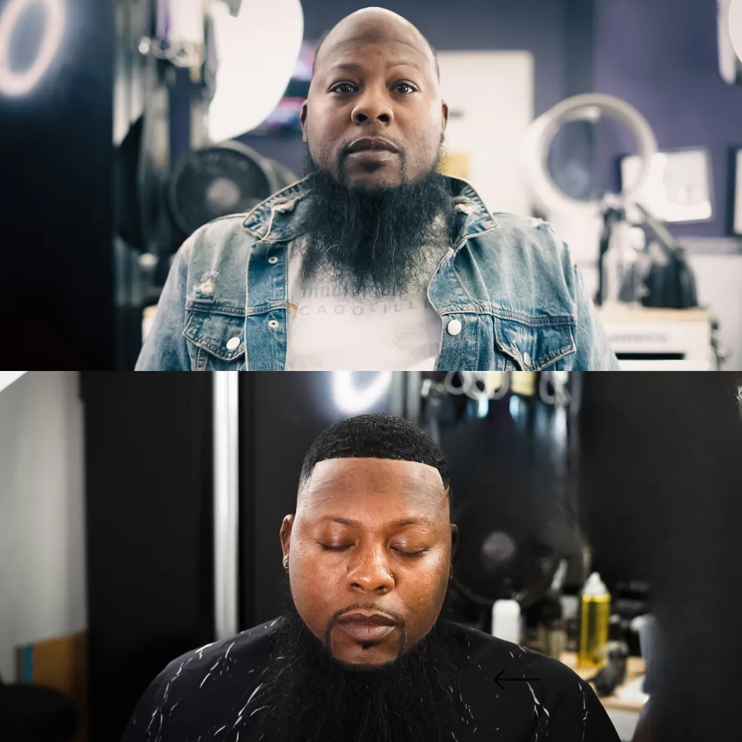 hair replacement in Dallas before and after results